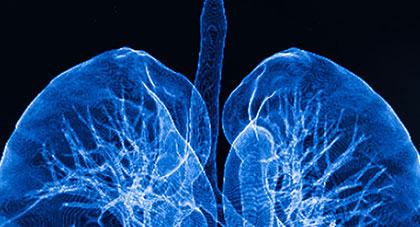 A diagnostic scan of a person's lungs.
