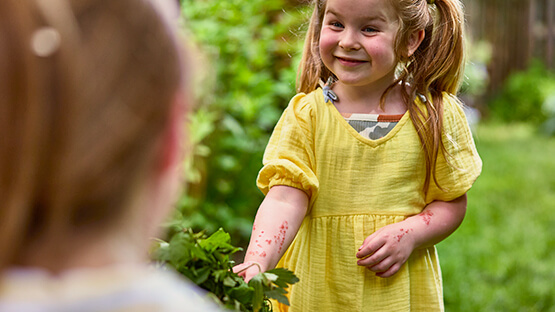 A young girl smiling while showing that she is holding a branch of leaves with a rash on her arm