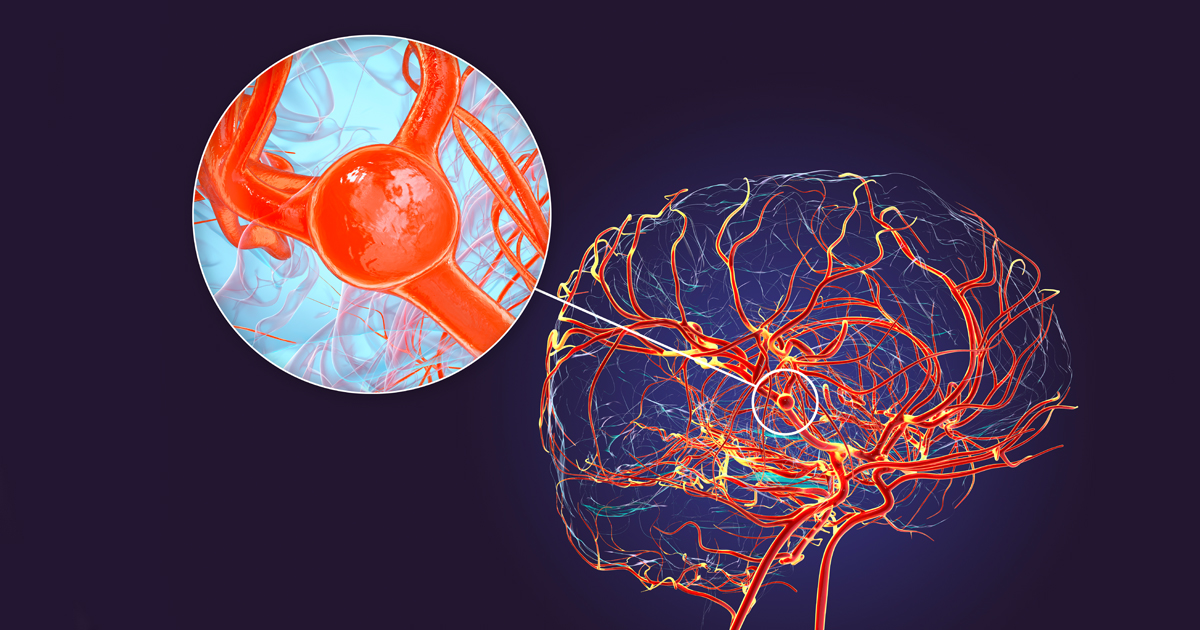 A brain diagram shows blood vessels, with a bubble-like aneurysm enlarged in a circle.
