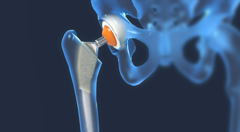 A computer generated x-ray image of a hip replacement