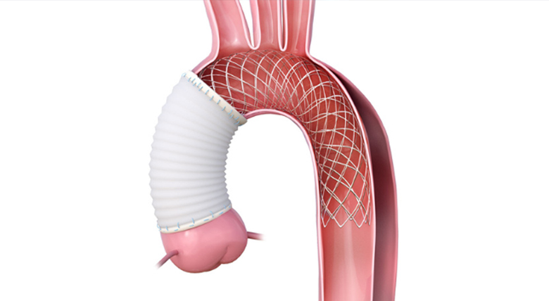 Image of aorta