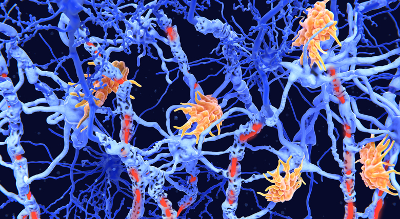 Microscopic view of nerve cells with damaged areas and surrounding support cells.