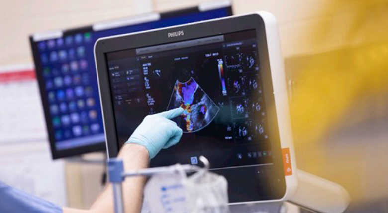 A gloved hand points to a heart scan on a Philips medical monitor.