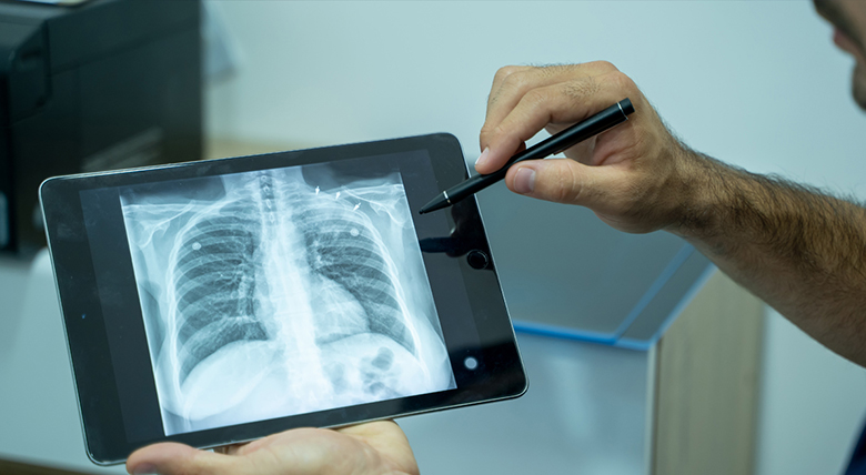 A person holds a tablet showing an X-ray of someone's lungs and chest.