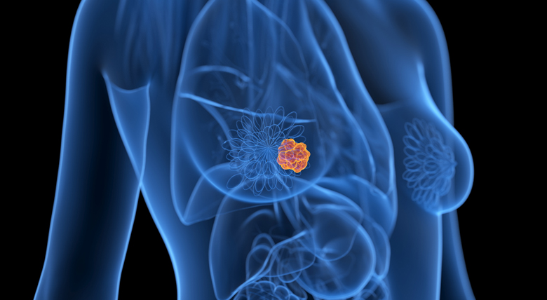 Clinical graphic showing breast cancer