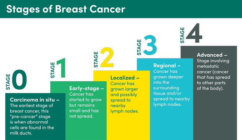 An illustration showing stages 0 to 4 of breast cancer