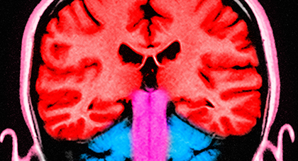 MRI Brain Scan example from the AHN Neuroscience Institute.
