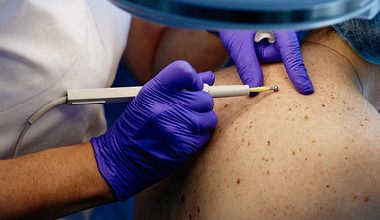 Doctor using a special tool to remove a mole