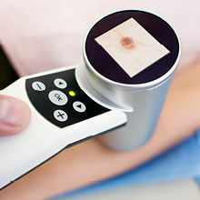Skin analysis tool used in the diagnosis of Merkel cell carcinoma being used on a patient's arm