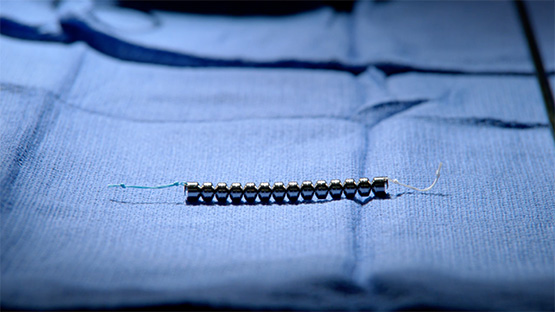 Metal beaded linx device on blue cloth.
