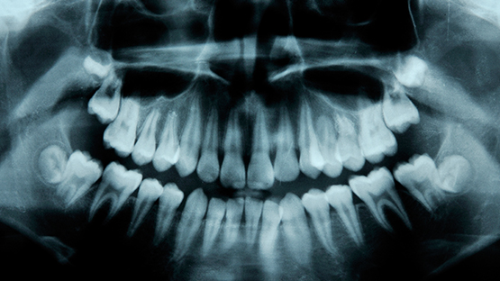 An x-ray of full set of teeth.
