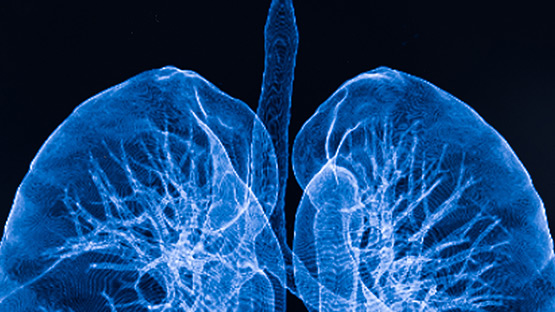 An x-ray of a set of lungs.