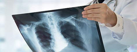 A doctor holding a chest x-ray and reviewing it.