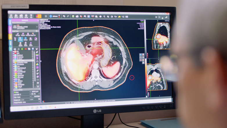 image of computer monitor showing shrinking liver tumor